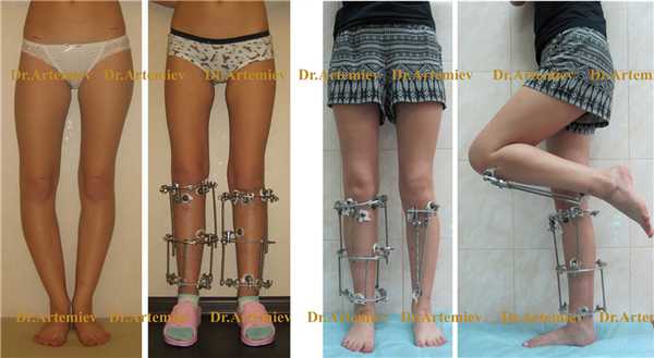 Внешний вид пациентки с варусной деформацией обеих голеней с использованием мини-фиксатора