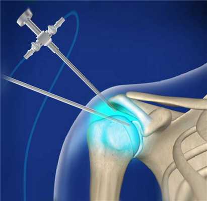 Артроскопия плечевого сустава