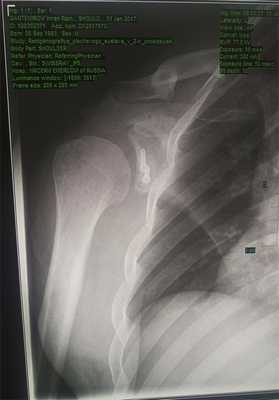 После артроскопической Латарже (2)