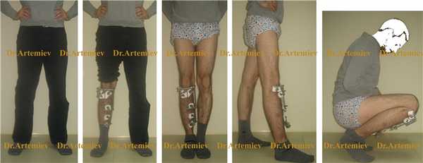 Внешний вид пациента с мини-аппаратом на голени в процессе коррекции деформации голени