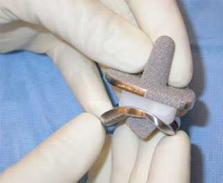 endoprotez-golenostopa