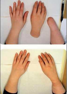 Кисть после ампутации протезируется силиконовым протезом