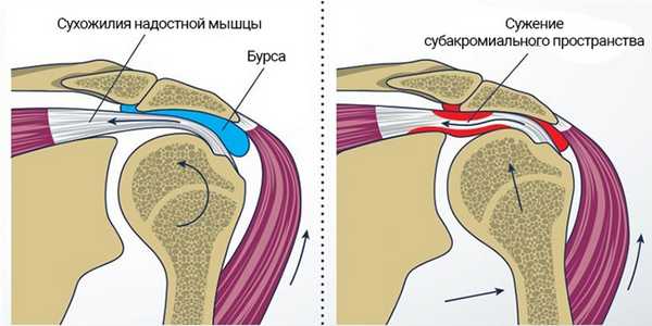 Артроскопическая субакромиальная декомпрессия
