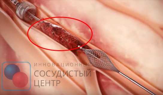Тромбэктомия - операция по удалению тромбов