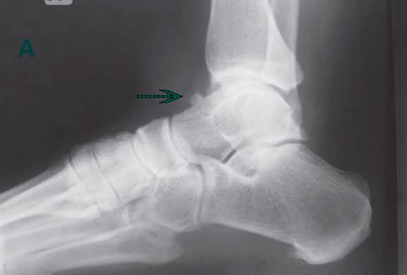 рентген остеофита таранной кости
