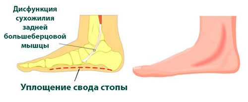 плоскостопие
