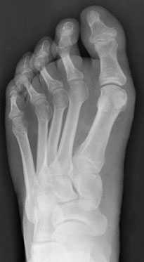 Рентгенограмма стопы