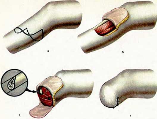 Лоскутная технология