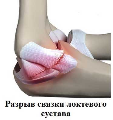 разрыв коллатеральной связки локтевого сустава