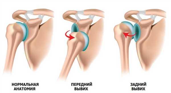 привычный вывих плеча