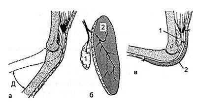Схема реконструкции локтевого сустава при его разгибательной контрактуре.