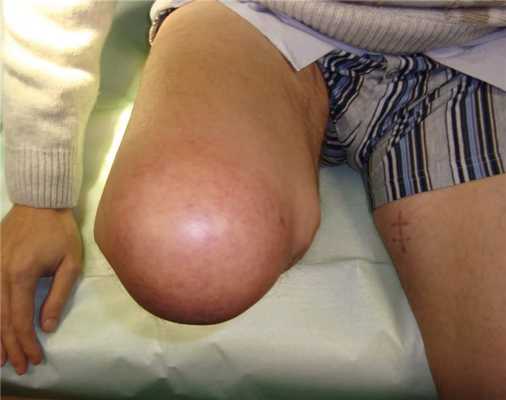 Опорная культя бедра