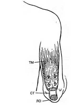 Схема пластики сухожилия трехглавой мышцы плеча.