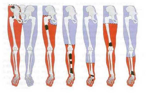 Уровни ампутации ноги