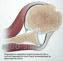 Повреждения возникающие при вывихе плеча