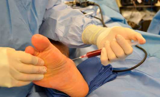 введение PRP в стопу