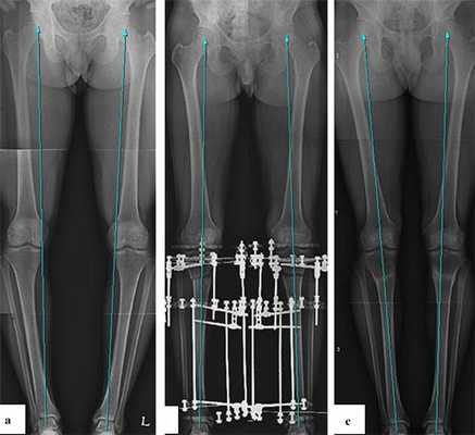 Коррекция оси нижней конечности при варусной деформации с помощью аппаратов Илизарова