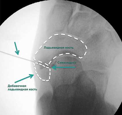 введение рентгенконтрастного препарата