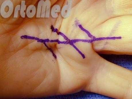 лечение с помощью опреации контрактуры Дюпюитрена