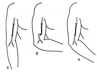 Особенности пластики плечевой артерии в ее нижней трети.