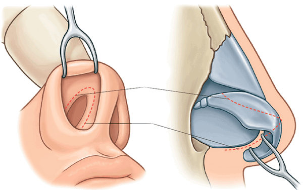 закрытая ринопластика, доступы при закрытой ринопластике