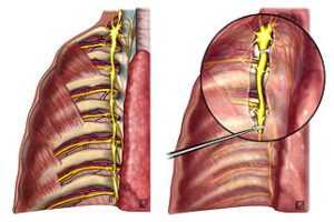 Грудная симпатэктомия