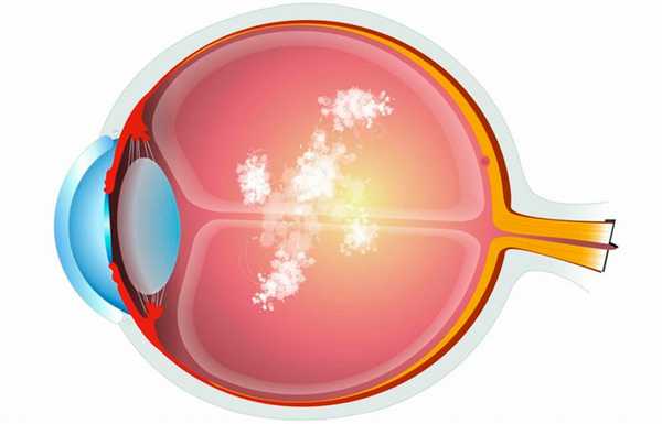 Стекловидное тело глаза