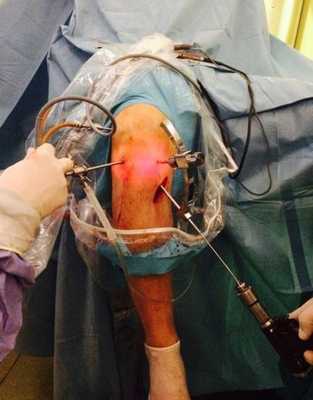 Рис. 2. Формирование большеберцового туннеля.