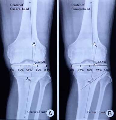 корригирующая остеотомия большеберцовой кости рассчёт угла