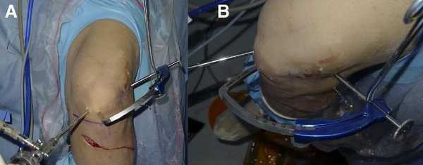 Рис. 4 (A, B). Классическая установка внутрисуставного наконечника бедреннного направителя через центральный порт установленный через связку надколенника [15].