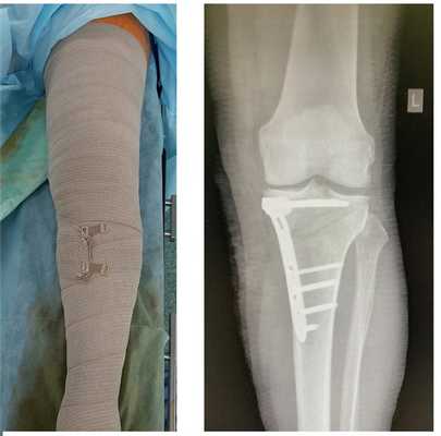 медиальный артроз коленного сустава, корригирующая остеотомия голени