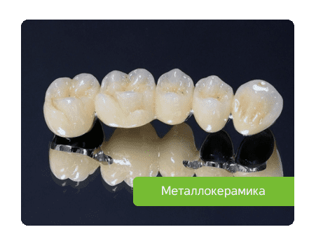 металлокерамический мост