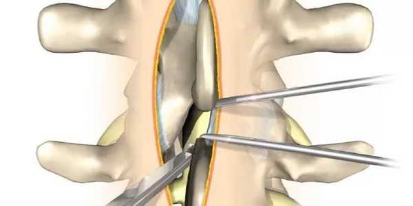 подготовка к ламинэктомии
