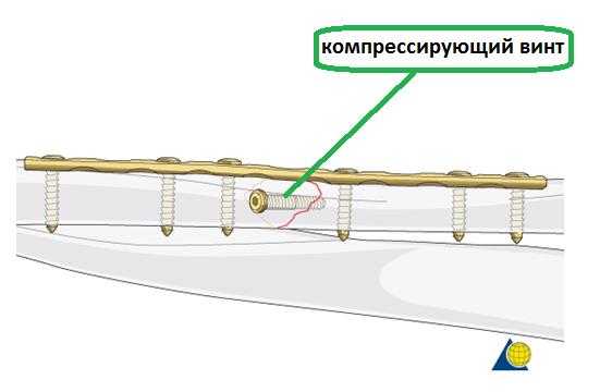 остеосинтез локтевой кости схема