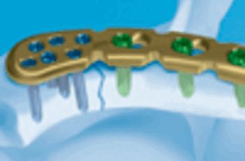 Этот метод лечения заключается в соединении отломков поврежденных костей для достижения репозиции отломков и восстановления целостности кости. Цель этой процедуры - обеспечить прочное соединение отломков для их полного сращения.