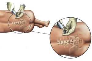 люмбальная пункция