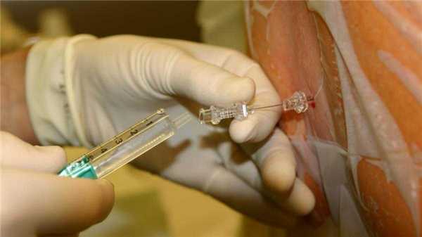 Люмбальная пункция 