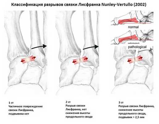 разрыв связки лисфранка
