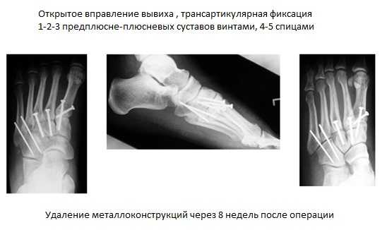 сустав лисфранка