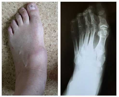 вывих в суставе Лисфранка