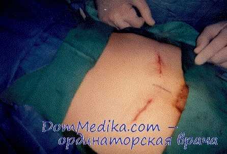 амбулаторная герниопластика