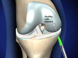 Трансплантация аутологичного хряща в коленном суставе