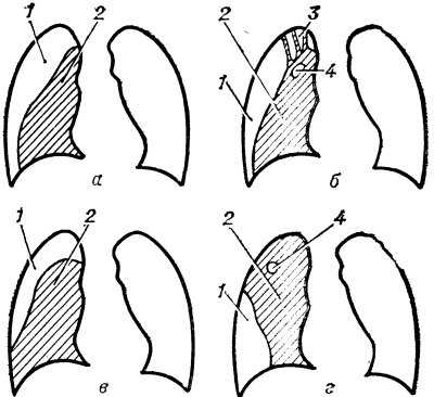 Рис. 3. Схематическое изображение вариантов искусственного пневмоторакса: а — оптимальный, б — неэффективный, в — селективно-положительный (очаг деструкции закрыт), г — селективно-отрицательный; 1 — газовый пузырь, 2 — коллабированкое легкое, 3 — плевральные спайки, 4 — неспавшаяся каверна.
