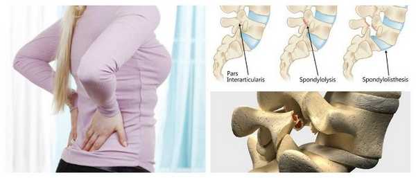 Спондилолистез