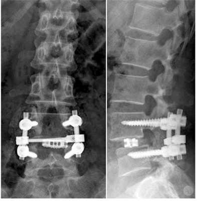 Операция по стабилизирующей методике с применением межтелового корпородеза имплантами