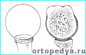 Патологии плечевого сустава
