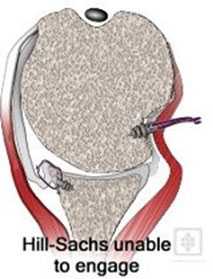 Лечение вывиха плечевого сустава