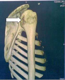 Лечение вывиха плечевого сустава