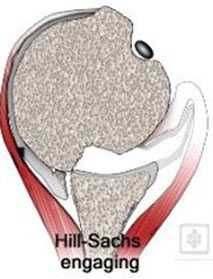 Лечение вывиха плечевого сустава