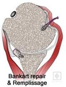 Лечение вывиха плечевого сустава